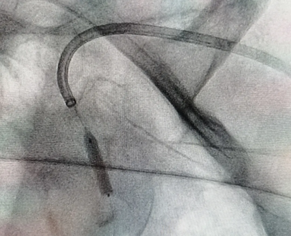 北京老年醫院成功完成經橈動脈入路慢性鎖骨下動脈閉塞再通術 北京老年醫院成功完成經橈動脈入路慢性鎖骨下動脈閉塞再通術