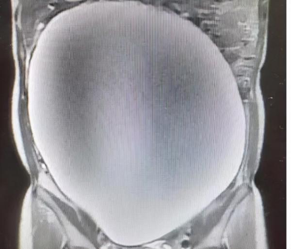 體內有癌,腹部先知?腹部的3個異常表現,或是暗示癌症已來臨 體內有癌,腹部先知?腹部的3個異常表現,或是暗示癌症已來臨