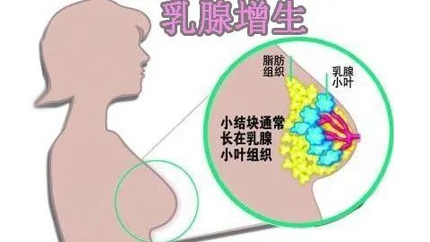 乳腺增生 消癖湯 乳腺增生 消癖湯
