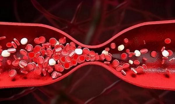兩種中成藥，多靶點“清理血液”，從根上疏通冠脈，改善心肌缺血