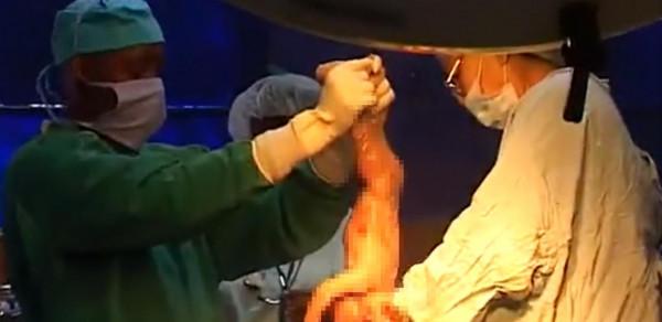 非洲醫院做手術，醫生就到點直接下班了