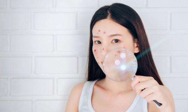 擺脫粉刺問題 用即時面部護膚方法