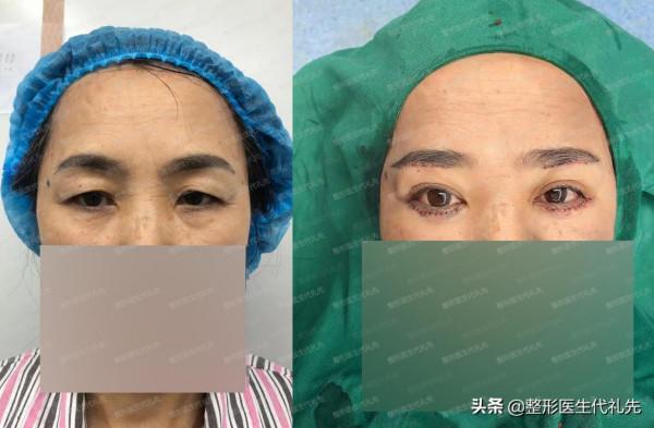 面部開始鬆弛下垂衰老的三大訊號，一定要開始注意了