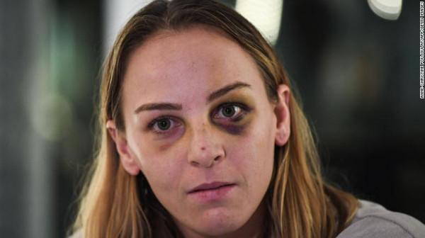 法國柔道冠軍妹子控告男友家暴，男友不服：看我都被揍成啥樣了