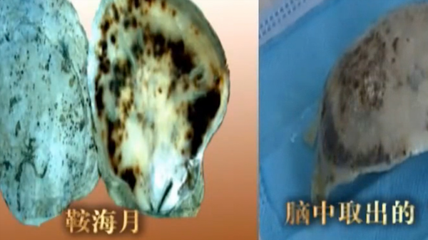 有人長六根手指，有人長兩顆腦袋，但你聽過人的頭上可以長貝殼嗎