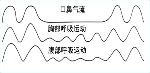 發現“反勺型”的高血壓,一定不要放過這個繼發性高血壓的病因 發現“反勺型”的高血壓,一定不要放過這個繼發性高血壓的病因