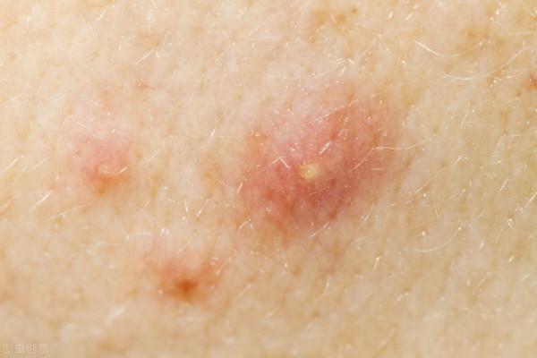 臉上長痘真的與對應的內臟健康有關係嗎？