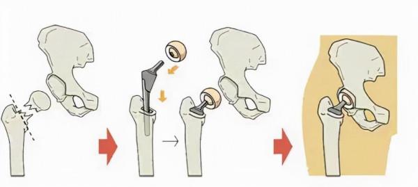 北京積水潭醫院牽頭的多中心研究表明：改善老年髖部骨折管理可顯著降低死亡風險