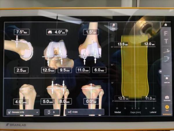 甘肅首例智慧導航全膝關節置換術順利完成