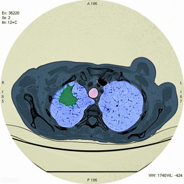 為何最懂養生的中醫主任得了癌症？