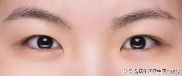 開眼角手術適合什麼樣的人群呢?丨科普篇 開眼角手術適合什麼樣的人群呢?丨科普篇