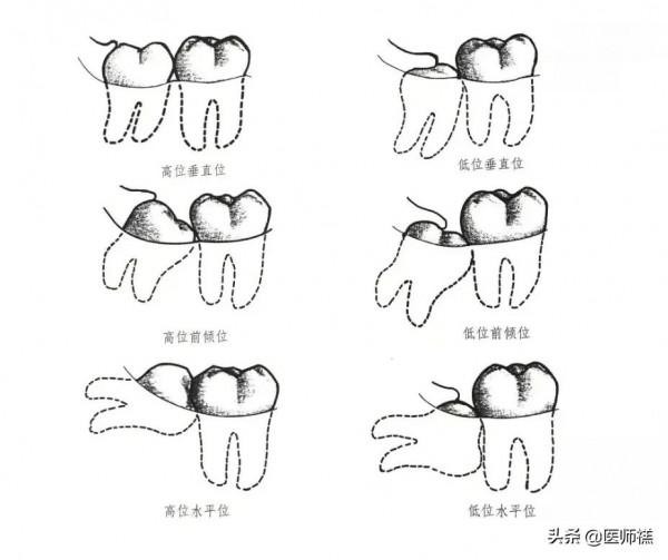 智齒為何總是成年出現?科學家給出結論,下巴空間有限 智齒為何總是成年出現?科學家給出結論,下巴空間有限