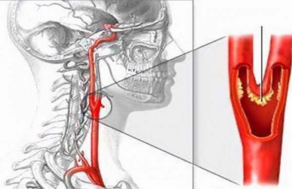 中年男子，頸動脈斑塊，吃了5年他汀，看看現在的檢查化驗結果