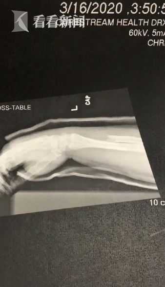 女子舉167公斤深蹲當場斷臂 骨頭差點刺穿面板