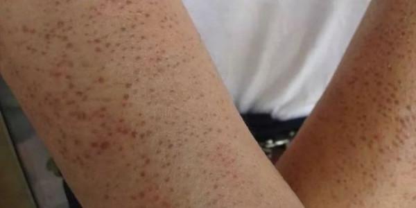 有的人腿上沒有毛髮是怎麼回事? 有的人腿上沒有毛髮是怎麼回事?