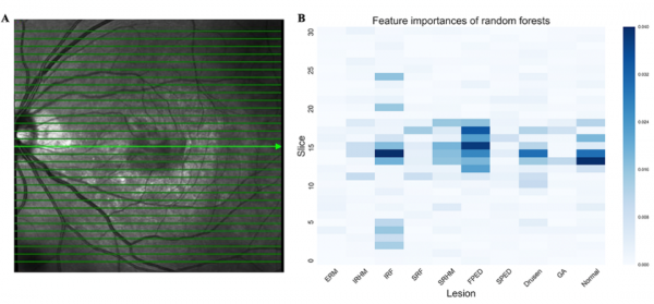 北京友誼醫院王康團隊在Retina發文：人工智慧框架的開發和驗證在黃斑疾病OCT影像中的應用