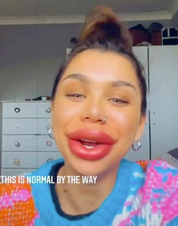 英國25歲女子後悔豐唇，為逆轉又進行溶解，男友：是什麼鬼東西？