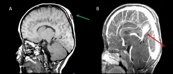 頭皮和顱骨病變的影像學特點 頭皮和顱骨病變的影像學特點
