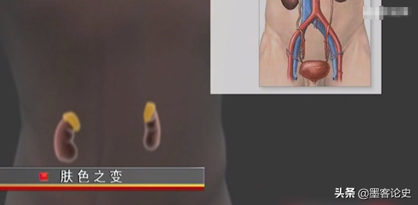 真實故事:山西45歲女子一夜變黑,體重急速增加,手術後讓家人落淚