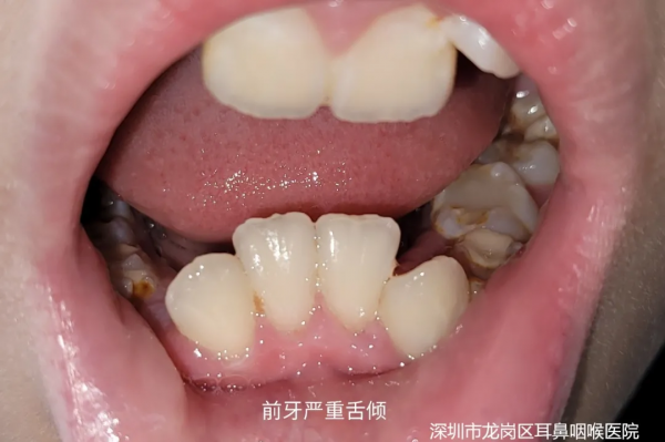 張口呼吸會長歪,用“閉嘴貼”?醫生:胡來! 張口呼吸會長歪,用“閉嘴貼”?醫生:胡來!