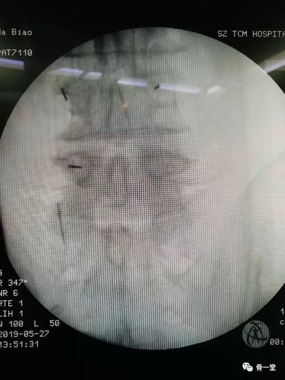真正的脊柱微創-misTLIF入路經脊柱內鏡下椎管減壓融合治療