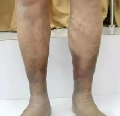 五體痺中脈痺如何治療呢? 五體痺中脈痺如何治療呢?