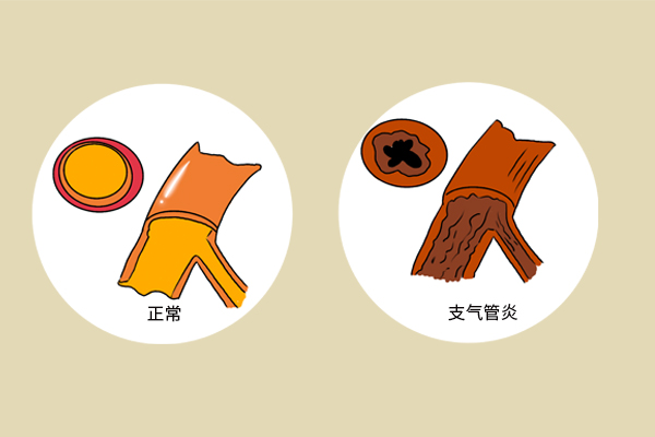 黃痰、白痰、黑痰、血性痰，分別提示什麼健康問題？痰多咋辦？