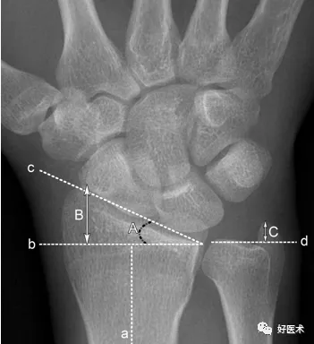 贊！腕關節X線高畫質解剖+腕骨脫位典型病例