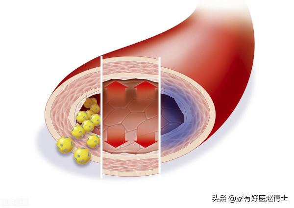 “血管老化”的五大常見徵象,您有嗎?及時干預,哪些藥物可選? “血管老化”的五大常見徵象,您有嗎?及時干預,哪些藥物可選?