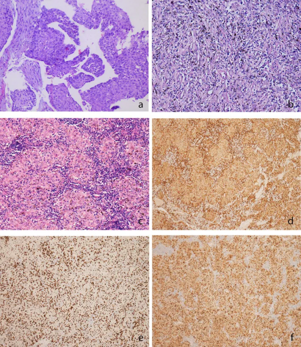 新輔助免疫聯合化療後出現DISR&srarr;病理完全緩解