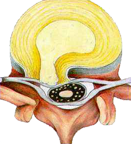 胖了更容易得腰突？肥胖的突友生活中要注意什麼？如何減肥鍛鍊？