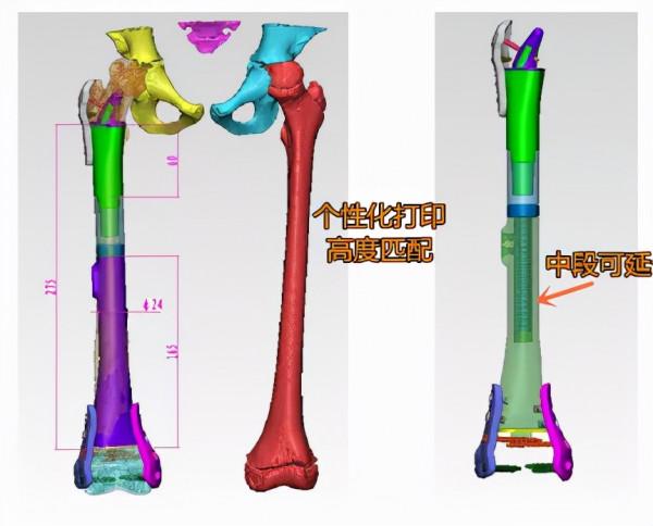 10歲女孩大腿疼一年多,醫生建議從大腿根處截肢 10歲女孩大腿疼一年多,醫生建議從大腿根處截肢