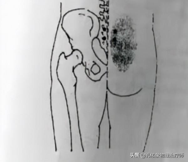 腰椎間盤突出，臀部疼痛、麻木，是怎麼回事？該如何治療