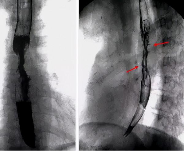 經典病例分享 | 多學科綜合治療區域性晚期食管癌完全緩解一例