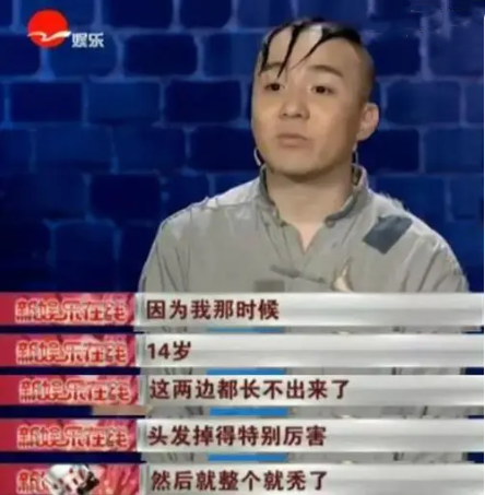 “三毛”長大了!8歲成名,14歲禿頂,34歲變帥哥,植髮挨300多針 “三毛”長大了!8歲成名,14歲禿頂,34歲變帥哥,植髮挨300多針