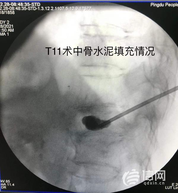 高齡患者遭遇車禍 平度市人民醫院微創手術恢復健康