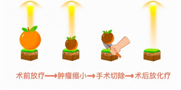 腸癌晚期也不要怕!一起帶你瞭解如何治療腸癌 腸癌晚期也不要怕!一起帶你瞭解如何治療腸癌