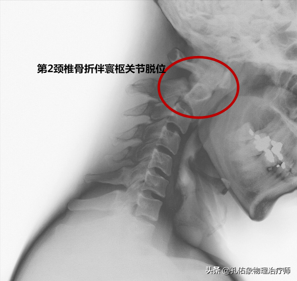 轉動脖子的時候咔咔響，是好還是壞？經常按摩的人，需要注意啥