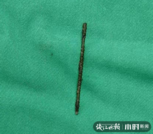 一根“繡花針”竟在女子體內藏了二十多年,醫生:運氣太好了 一根“繡花針”竟在女子體內藏了二十多年,醫生:運氣太好了