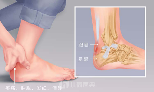 跟腱炎的疼痛位置圖