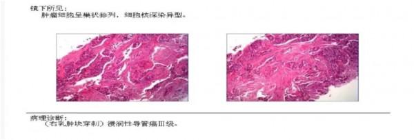 愈見未萊 | 赫帕雙靶新輔助治療HER-2+可手術乳腺癌患者，療效和安全性兼可得