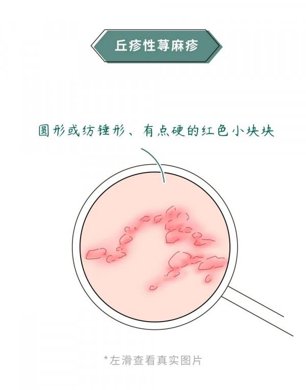 漫畫科普：“揹負”太多，“疹”的很累！