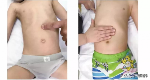 小兒推拿保健四穴 小兒推拿保健四穴