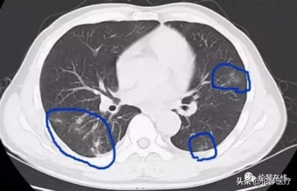 這種吃螃蟹吃出的怪病,影像醫生都是怎麼診斷的?|倫琴醫療 這種吃螃蟹吃出的怪病,影像醫生都是怎麼診斷的?|倫琴醫療