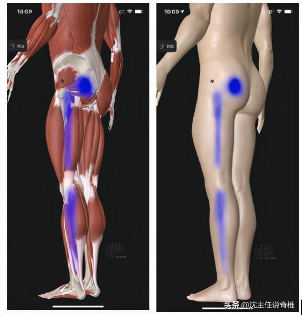 臀痛、腿麻就一定是腰突症？這些原因也莫忽視