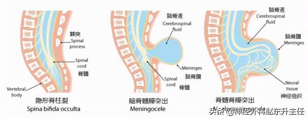 脊柱裂是什麼病？大小便障礙該怎麼治療？