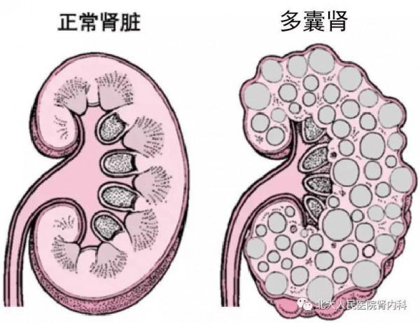 很多器官會長囊腫,囊腫會惡變嗎?盤點體內常見部位的囊腫 很多器官會長囊腫,囊腫會惡變嗎?盤點體內常見部位的囊腫