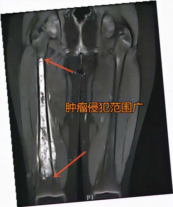 10歲女孩大腿疼一年多,醫生建議從大腿根處截肢 10歲女孩大腿疼一年多,醫生建議從大腿根處截肢