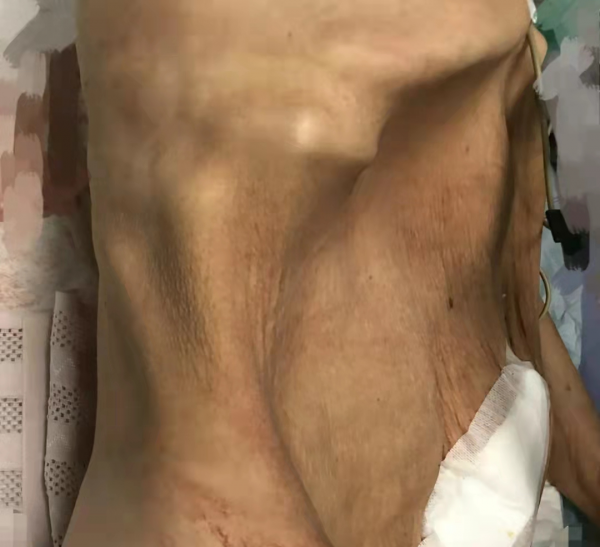 天啊!切除下的巨大腫瘤重達44斤!廈門大學附屬中山醫院成功完成 天啊!切除下的巨大腫瘤重達44斤!廈門大學附屬中山醫院成功完成