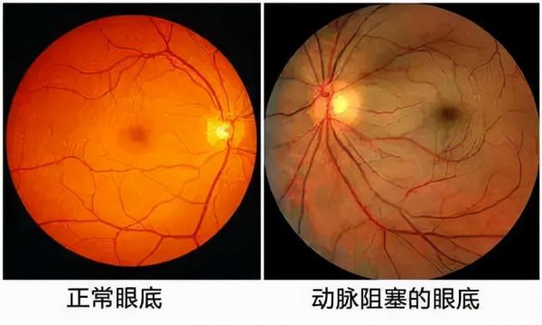 「眼病預警」當眼睛出現這些症狀，要注意了